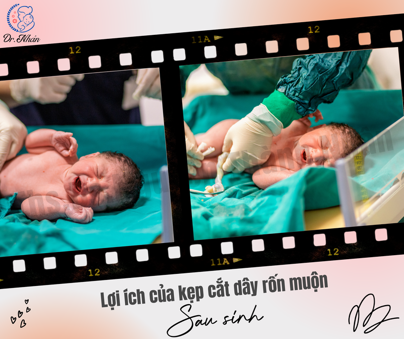 LỢI ÍCH CỦA KẸP CẮT DÂY RỐN MUỘN SAU SINH