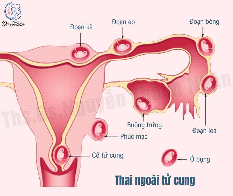 THAI NGOÀI TỬ CUNG