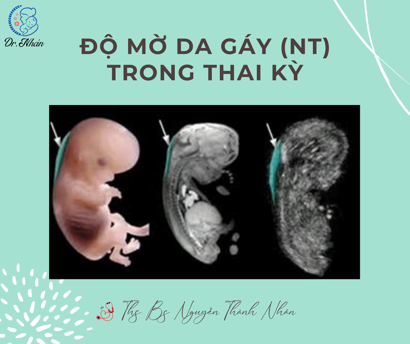 ĐỘ MỜ DA GÁY (NT) TRONG THAI KỲ