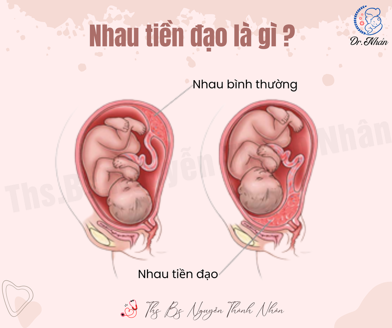 NHAU TIỀN ĐẠO NGUY HIỂM NHƯ THẾ NÀO?