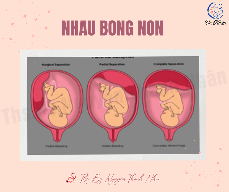 LÀM SAO NHẬN BIẾT SỚM TÌNH TRẠNG NHAU BONG NON?