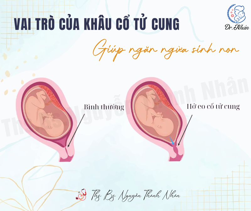 VAI TRÒ CỦA KHÂU CỔ TỬ CUNG TRONG VIỆC NGĂN NGỪA SINH NON
