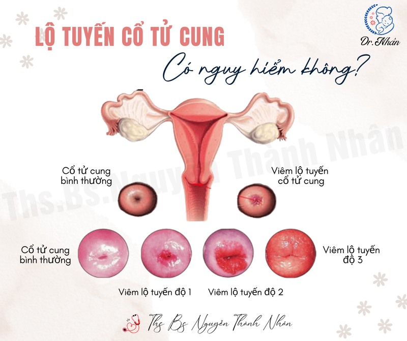 LỘ TUYẾN CỔ TỬ CUNG