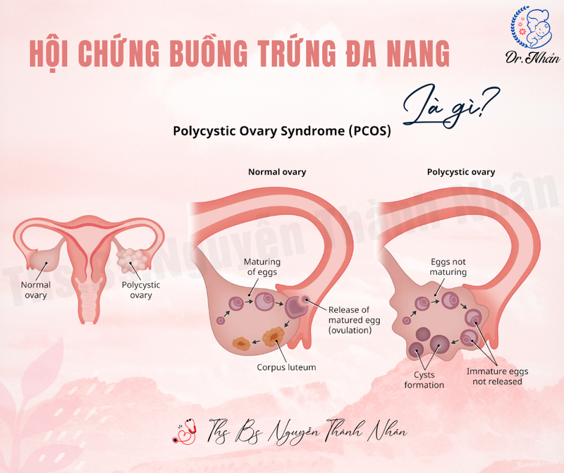 HỘI CHỨNG BUỒNG TRỨNG ĐA NANG